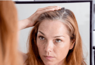 Saç egzeması nedir?