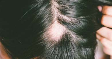 Kadınlarda Erkek Tipi Saç Dökülmesi