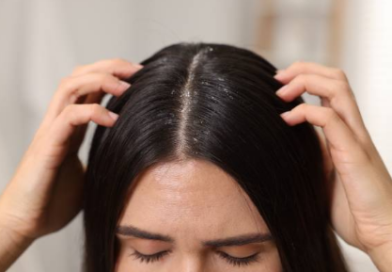 Saç Derisinde Kabuklanma