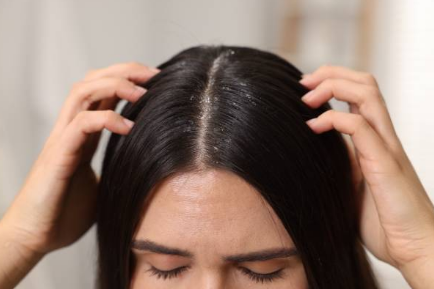 Saç Derisinde Kabuklanma