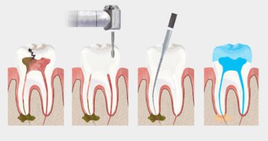 Kanal tedavisi nasıl yapılır