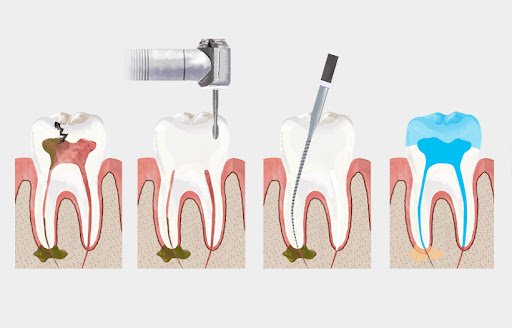 Kanal tedavisi nasıl yapılır